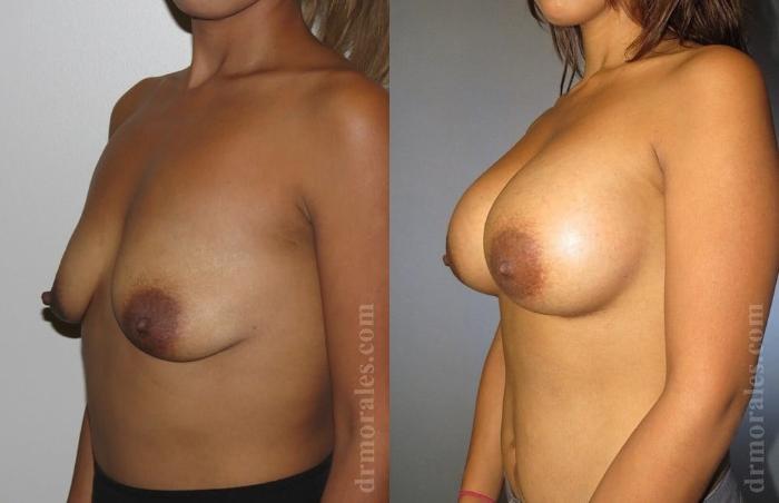 Before & After Breast Augmentation Case 765 View 1 View in Houston, TX