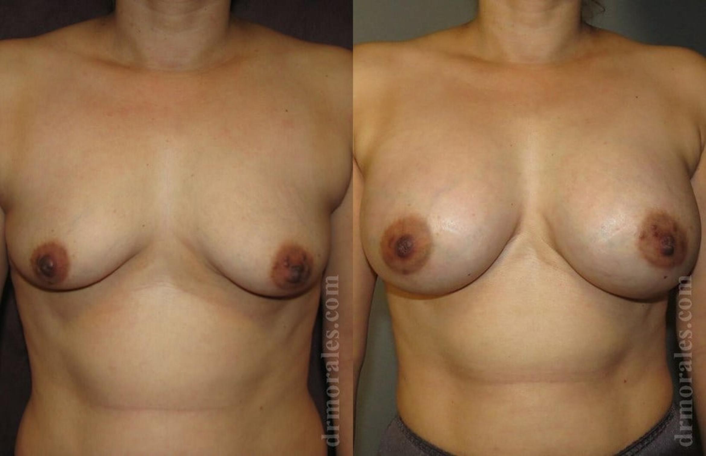 Before & After Breast Augmentation Case 766 View 1 View in Houston, TX