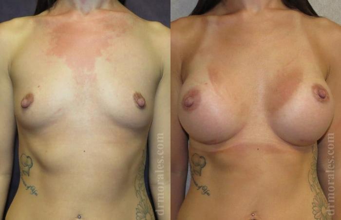 Before & After Breast Augmentation Case 767 View 1 View in Houston, TX