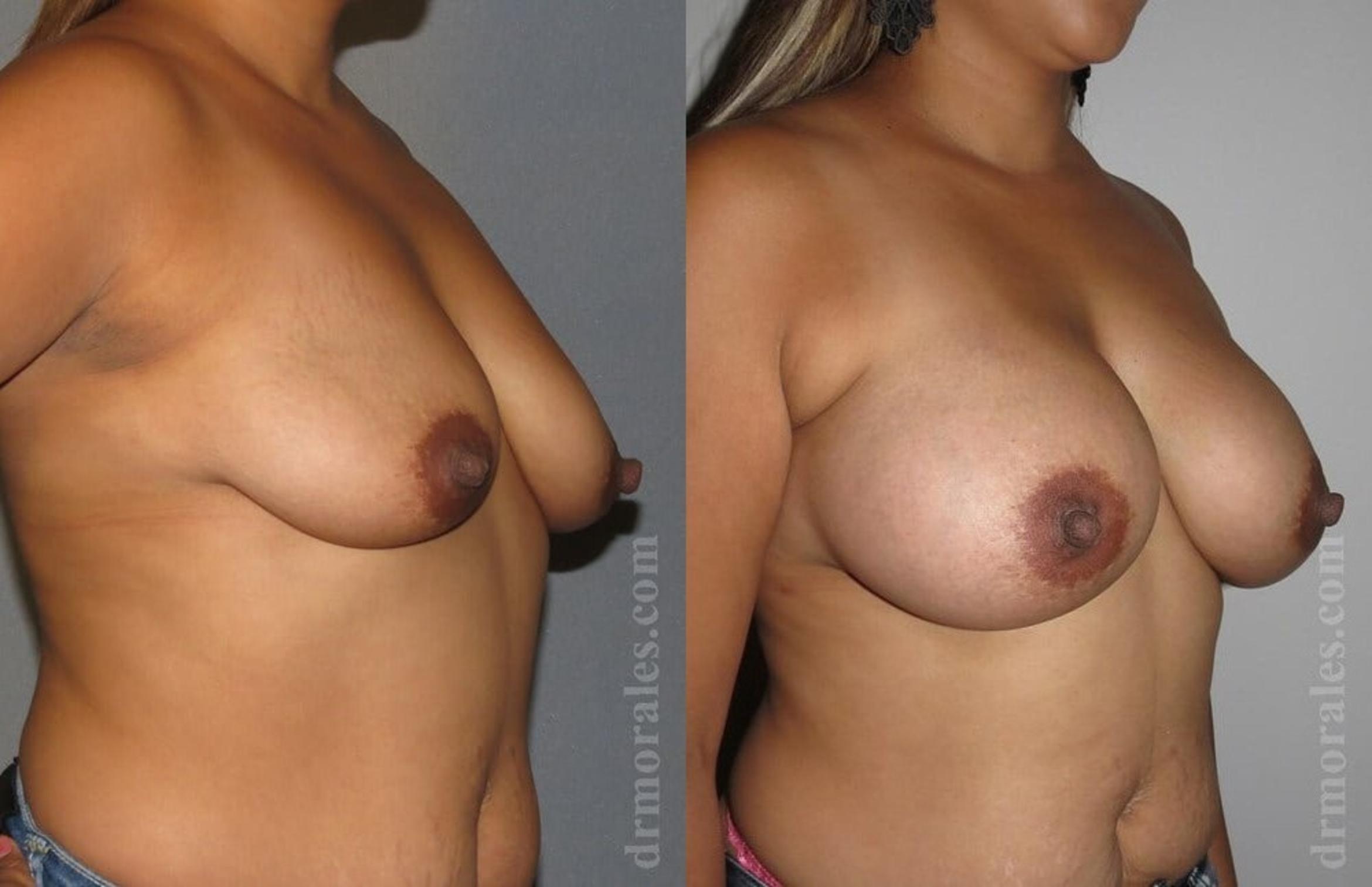 Before & After Breast Augmentation Case 768 View 1 View in Houston, TX