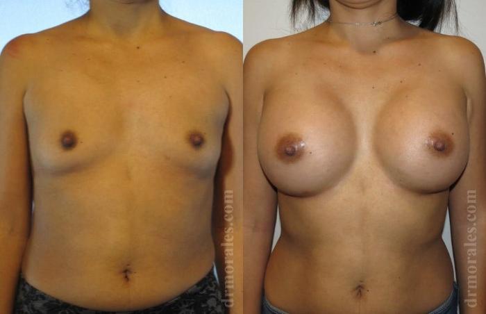 Before & After Breast Augmentation Case 769 View 1 View in Houston, TX