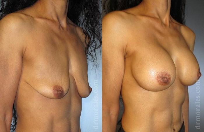 Before & After Breast Augmentation Case 770 View 1 View in Houston, TX