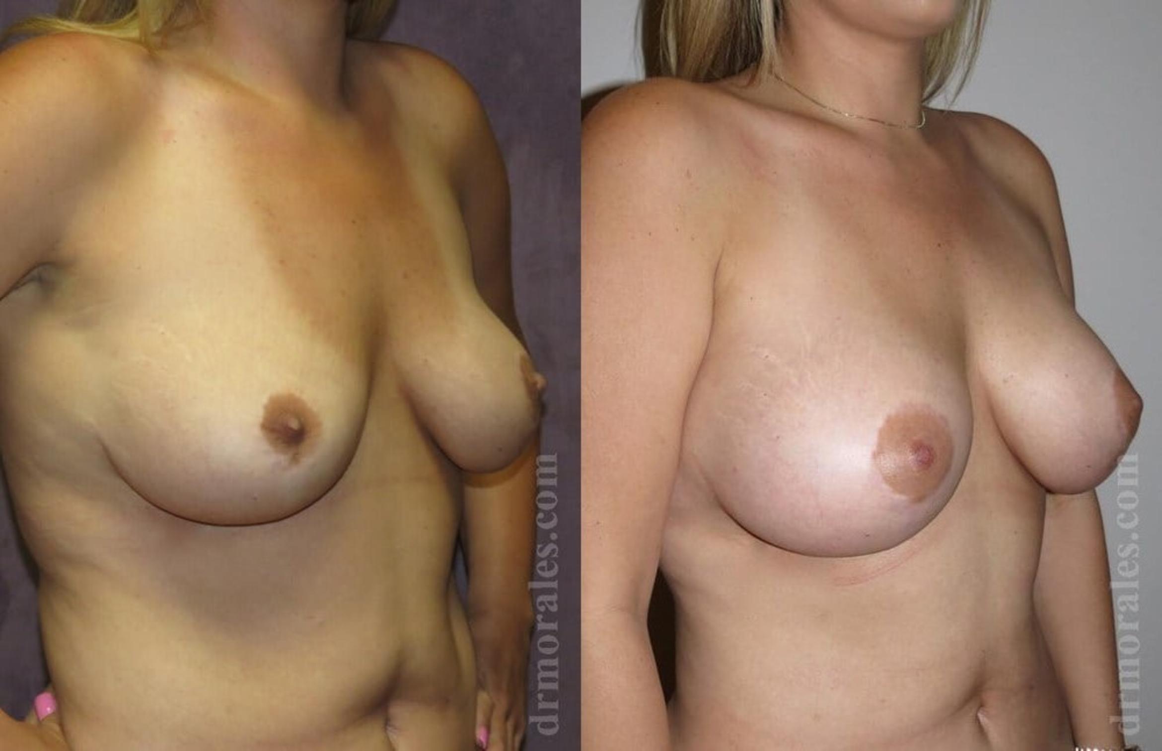 Before & After Breast Augmentation Case 771 View 1 View in Houston, TX