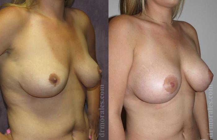 Before & After Breast Augmentation Case 771 View 1 View in Houston, TX