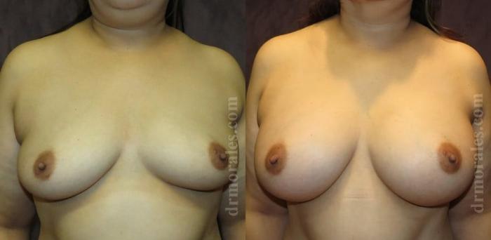 Before & After Breast Augmentation Case 772 View 1 View in Houston, TX