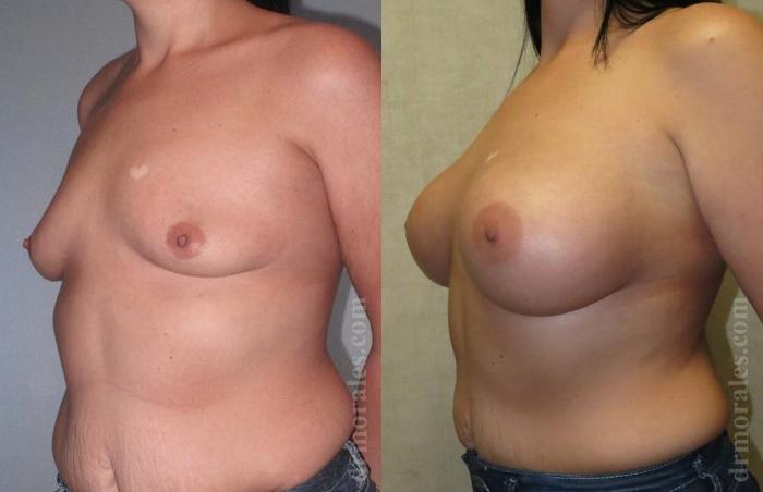 Before & After Breast Augmentation Case 773 View 1 View in Houston, TX
