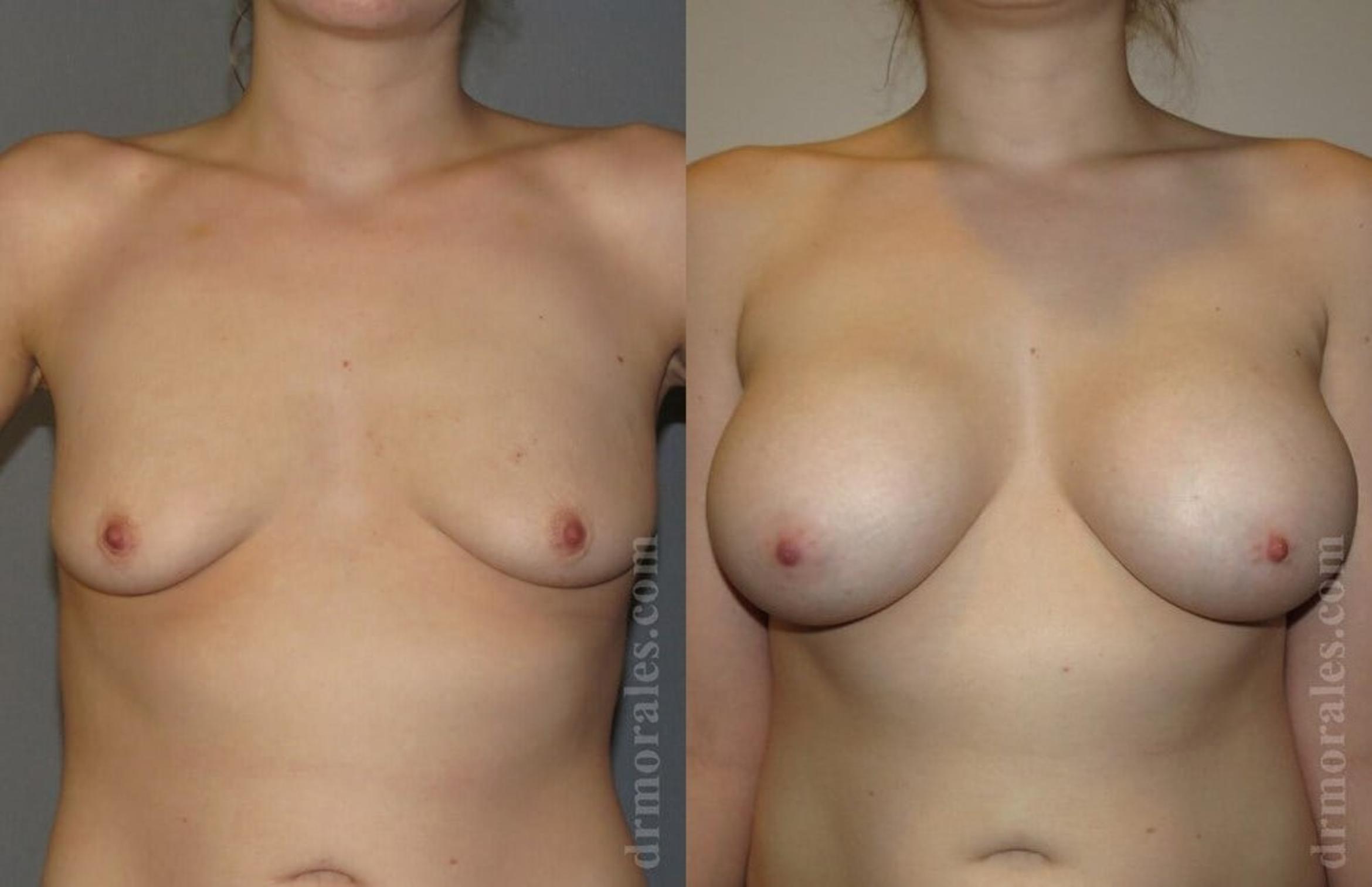 Before & After Breast Augmentation Case 774 View 1 View in Houston, TX