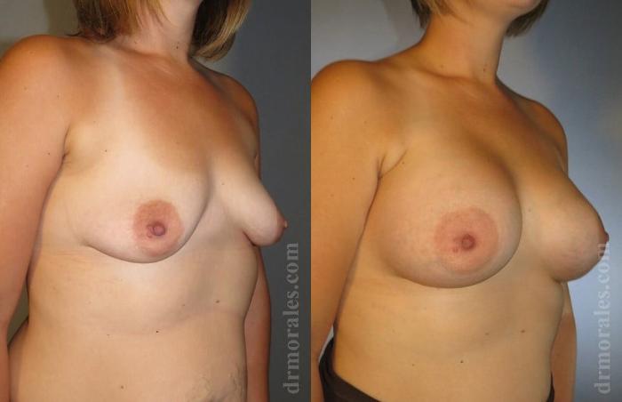Before & After Breast Augmentation Case 775 View 1 View in Houston, TX
