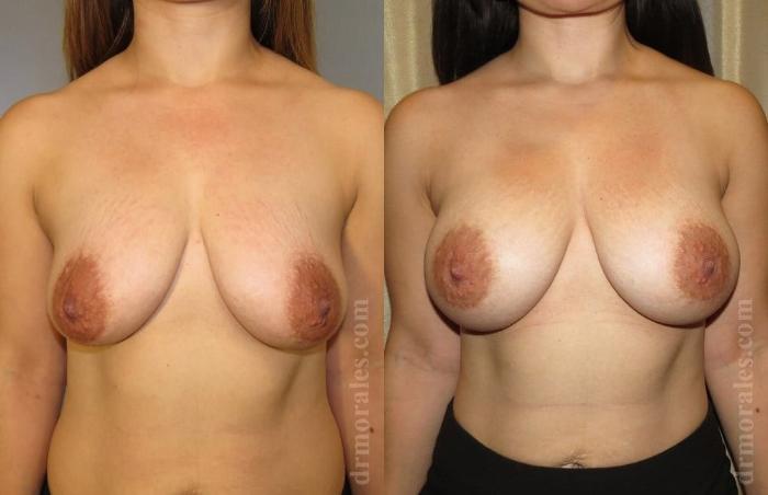 Before & After Breast Augmentation Case 776 View 1 View in Houston, TX