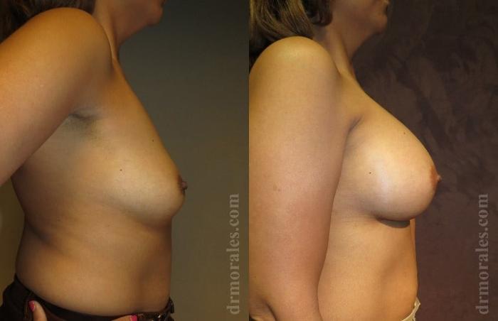 Before & After Breast Augmentation Case 777 View 1 View in Houston, TX