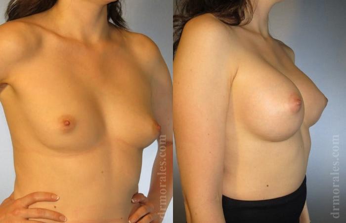 Before & After Breast Augmentation Case 778 View 1 View in Houston, TX
