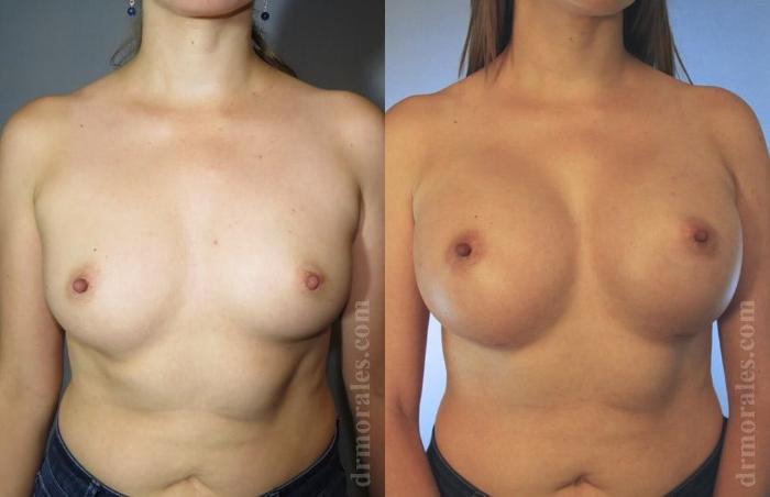 Before & After Breast Augmentation Case 779 View 1 View in Houston, TX