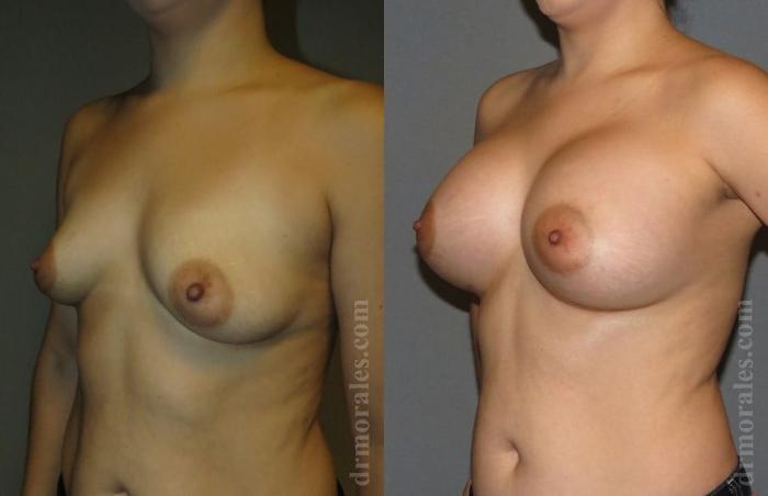 Before & After Breast Augmentation Case 780 View 1 View in Houston, TX