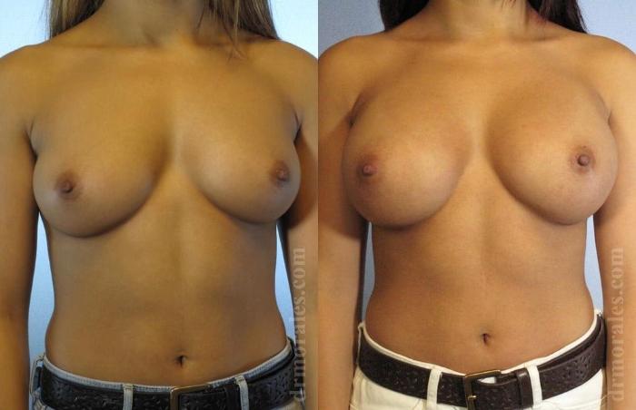 Before & After Breast Augmentation Case 781 View 1 View in Houston, TX