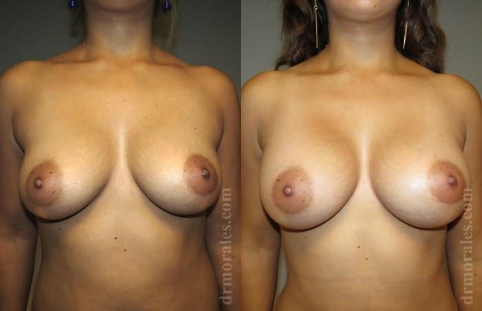 Before & After Breast Augmentation Case 784 View 1 View in Houston, TX