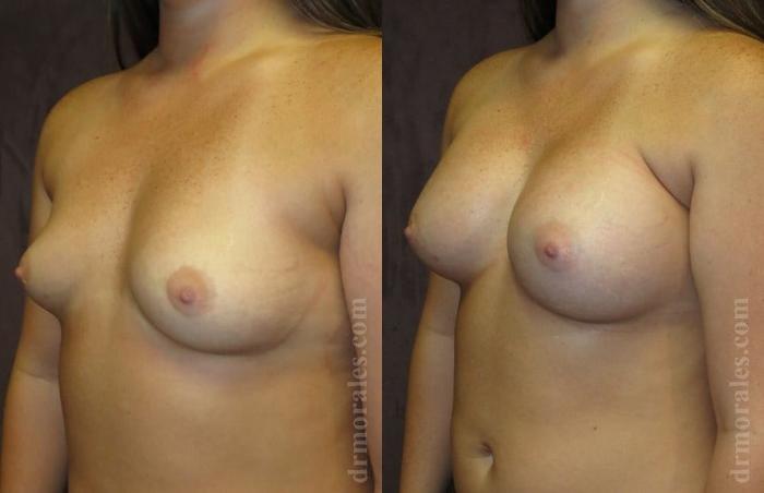 Before & After Breast Augmentation Case 785 View 1 View in Houston, TX