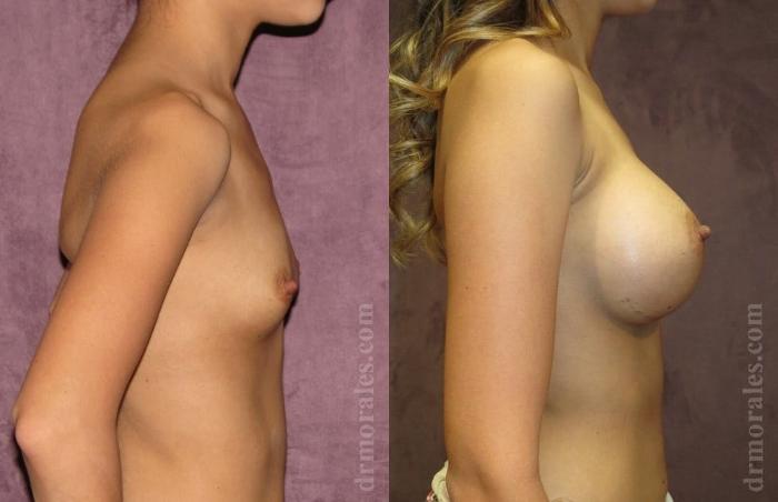 Before & After Breast Augmentation Case 786 View 1 View in Houston, TX