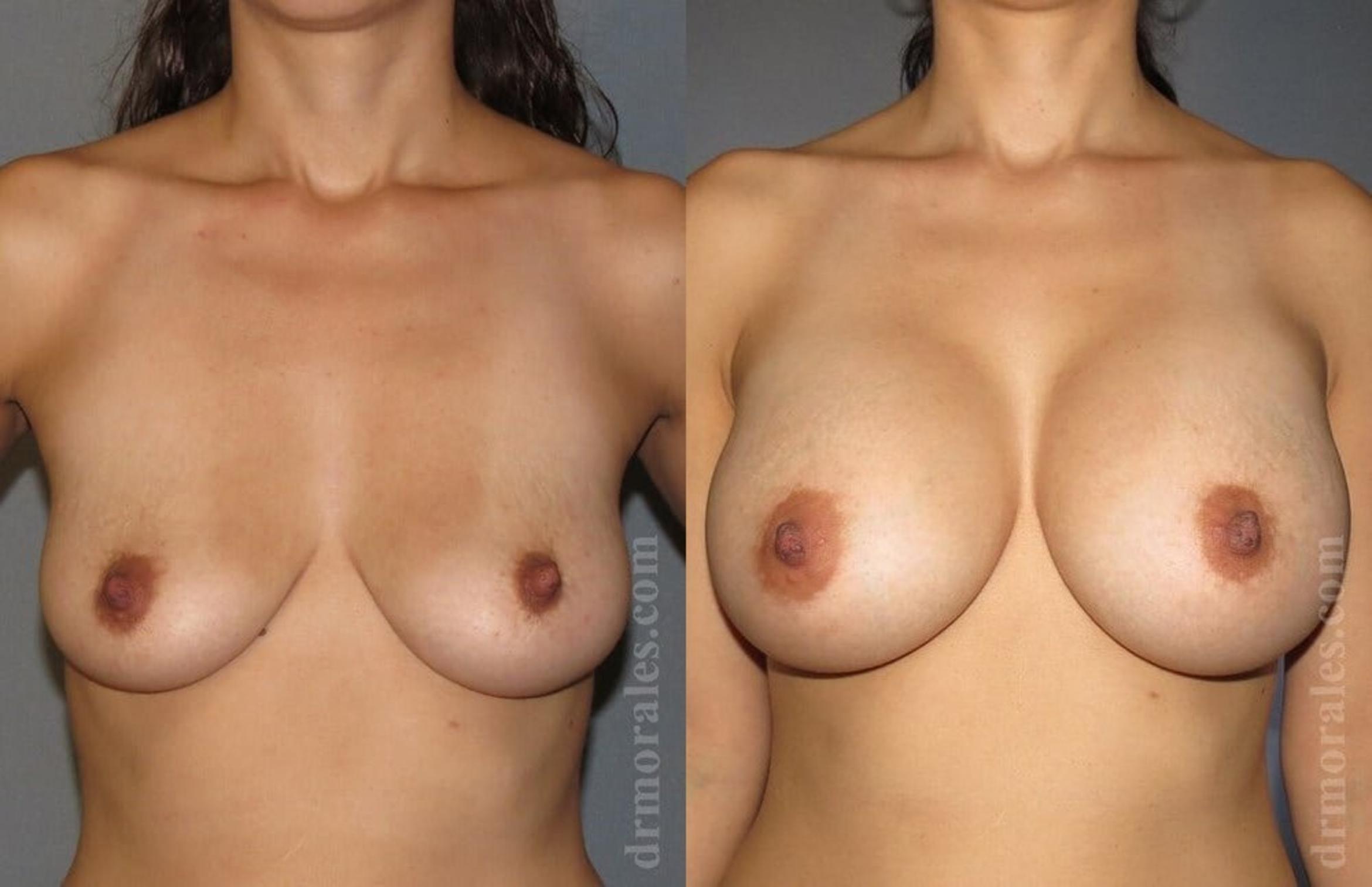 Before & After Breast Augmentation Case 787 View 1 View in Houston, TX