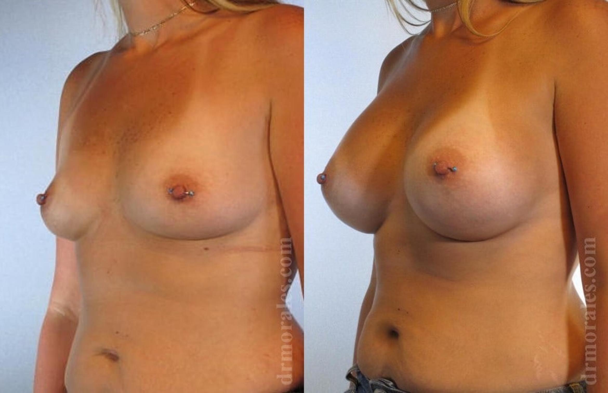 Before & After Breast Augmentation Case 790 View 1 View in Houston, TX
