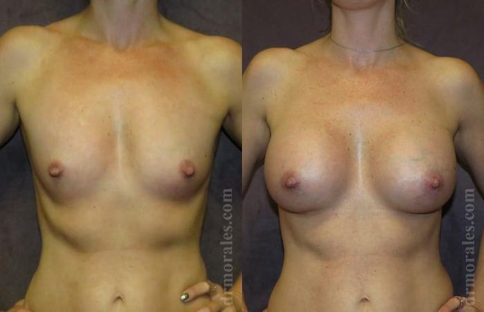 Before & After Breast Augmentation Case 793 View 1 View in Houston, TX