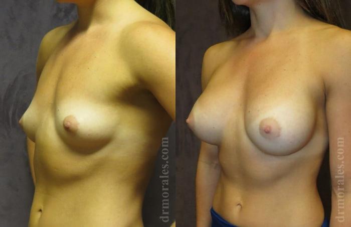 Before & After Breast Augmentation Case 795 View 1 View in Houston, TX