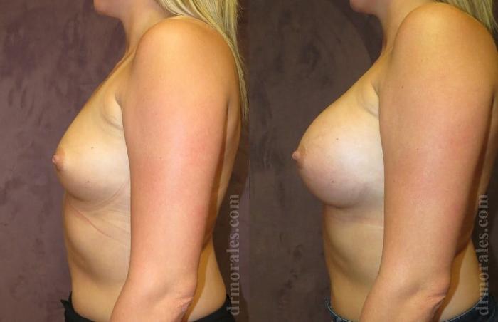 Before & After Breast Augmentation Case 796 View 1 View in Houston, TX