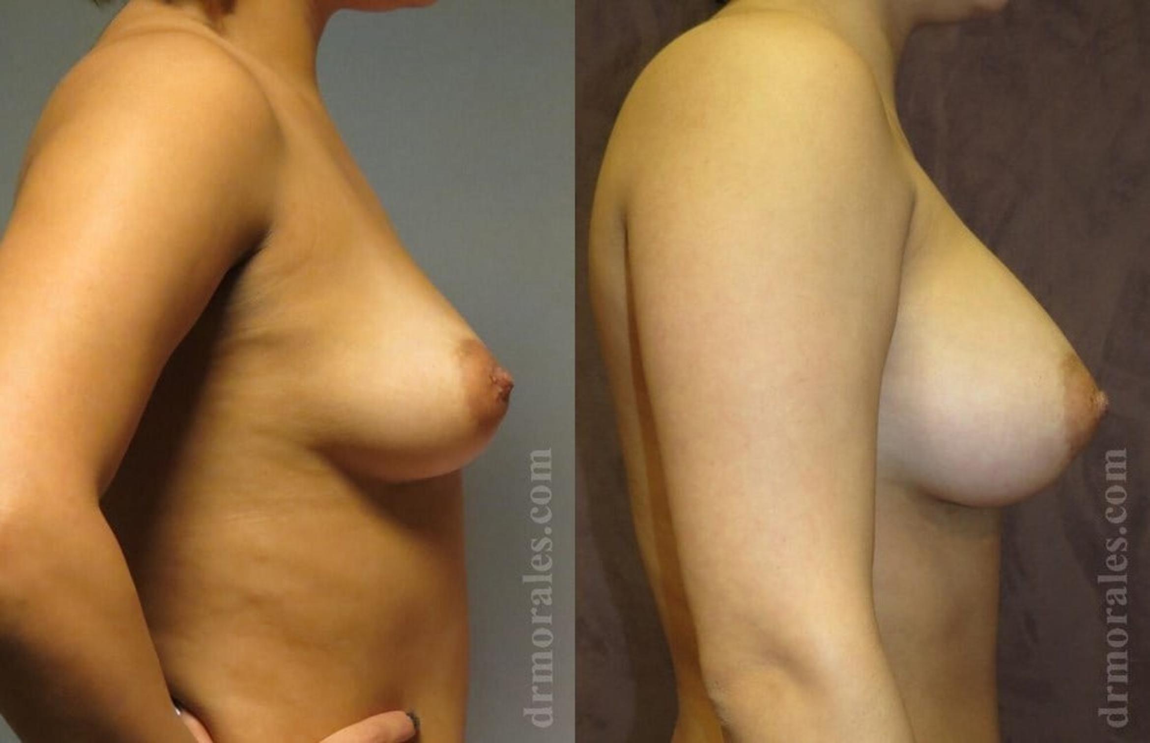 Before & After Breast Augmentation Case 797 View 1 View in Houston, TX