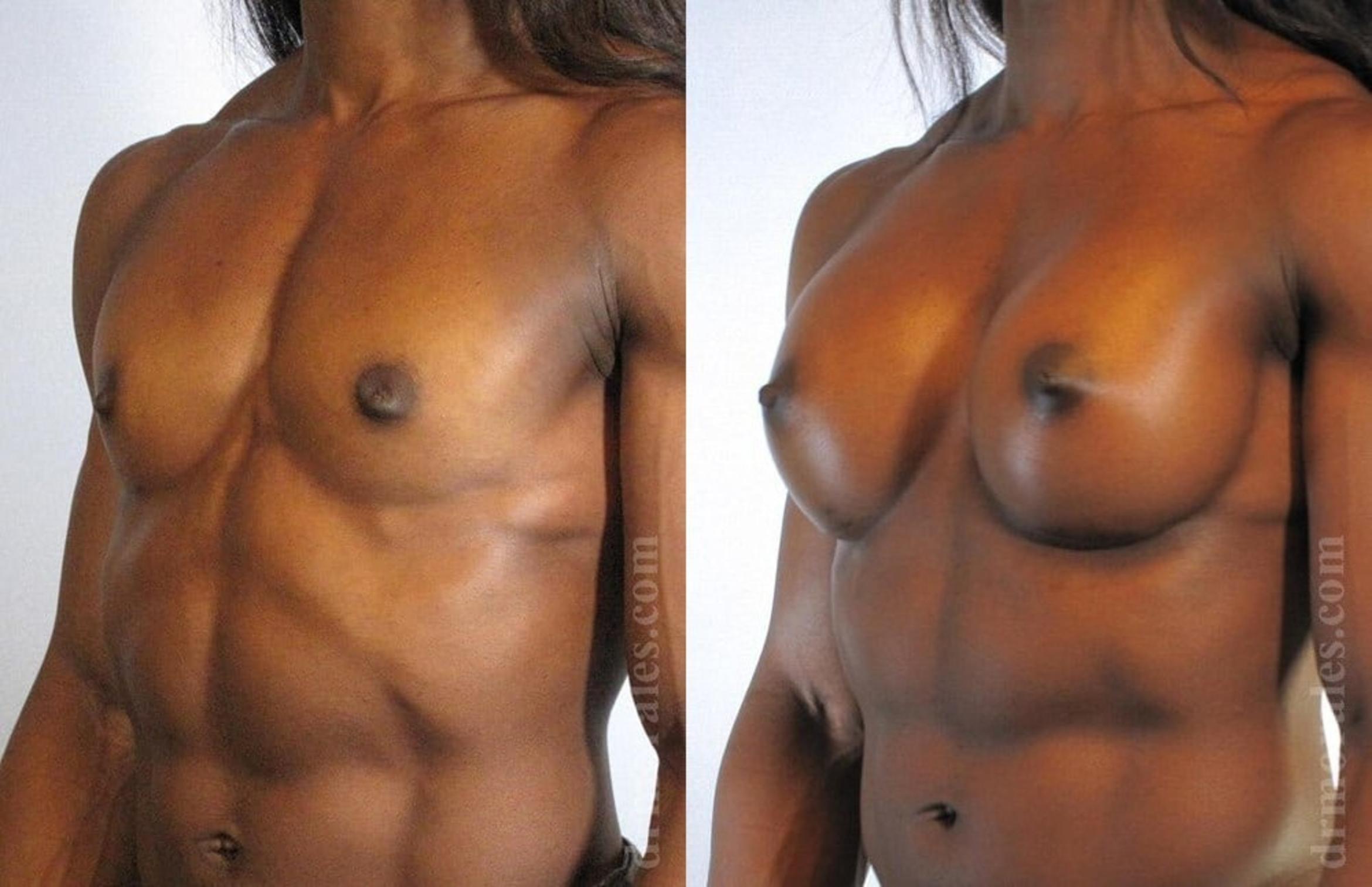 Before & After Breast Augmentation Case 800 View 1 View in Houston, TX