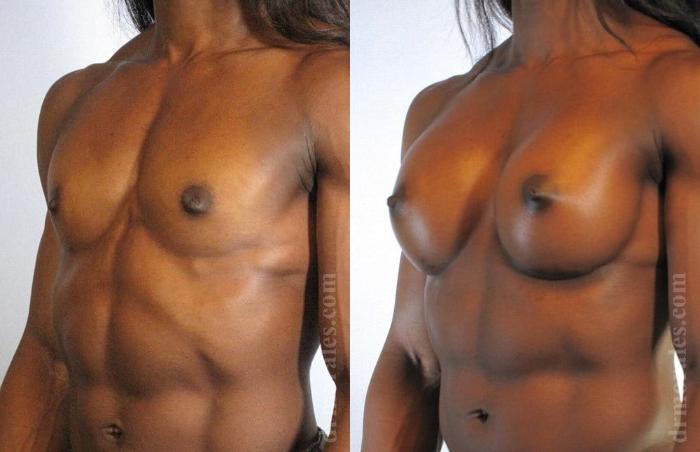 Before & After Breast Augmentation Case 800 View 1 View in Houston, TX
