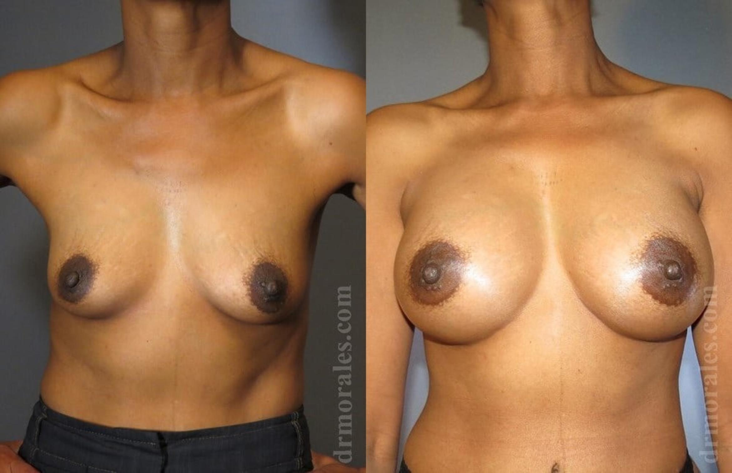 Before & After Breast Augmentation Case 801 View 1 View in Houston, TX