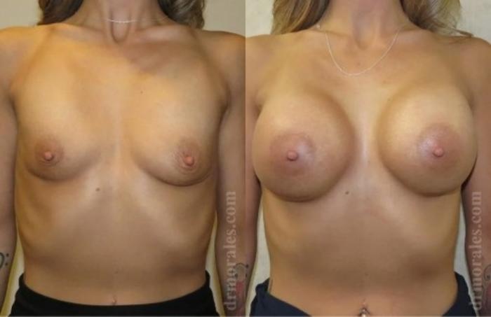 Before & After Breast Augmentation Case 803 View 1 View in Houston, TX