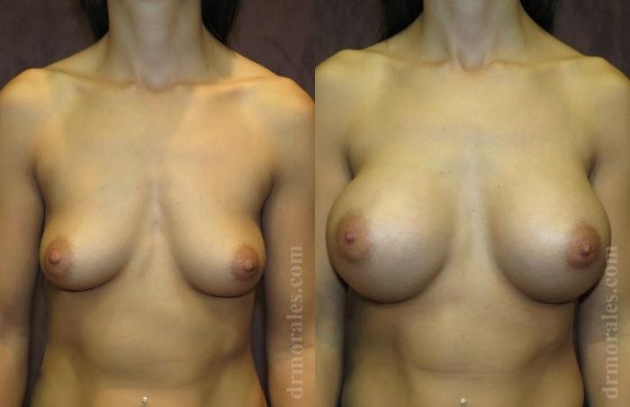 Before & After Breast Augmentation Case 804 View 1 View in Houston, TX