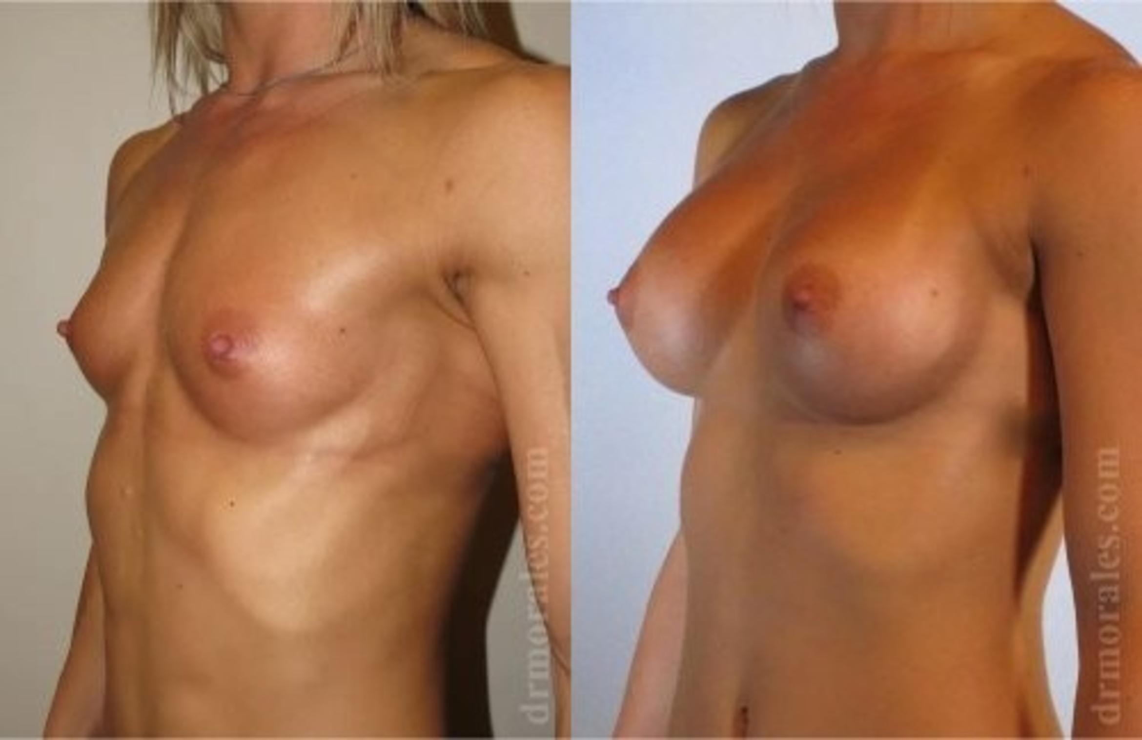 Before & After Breast Augmentation Case 807 View 1 View in Houston, TX