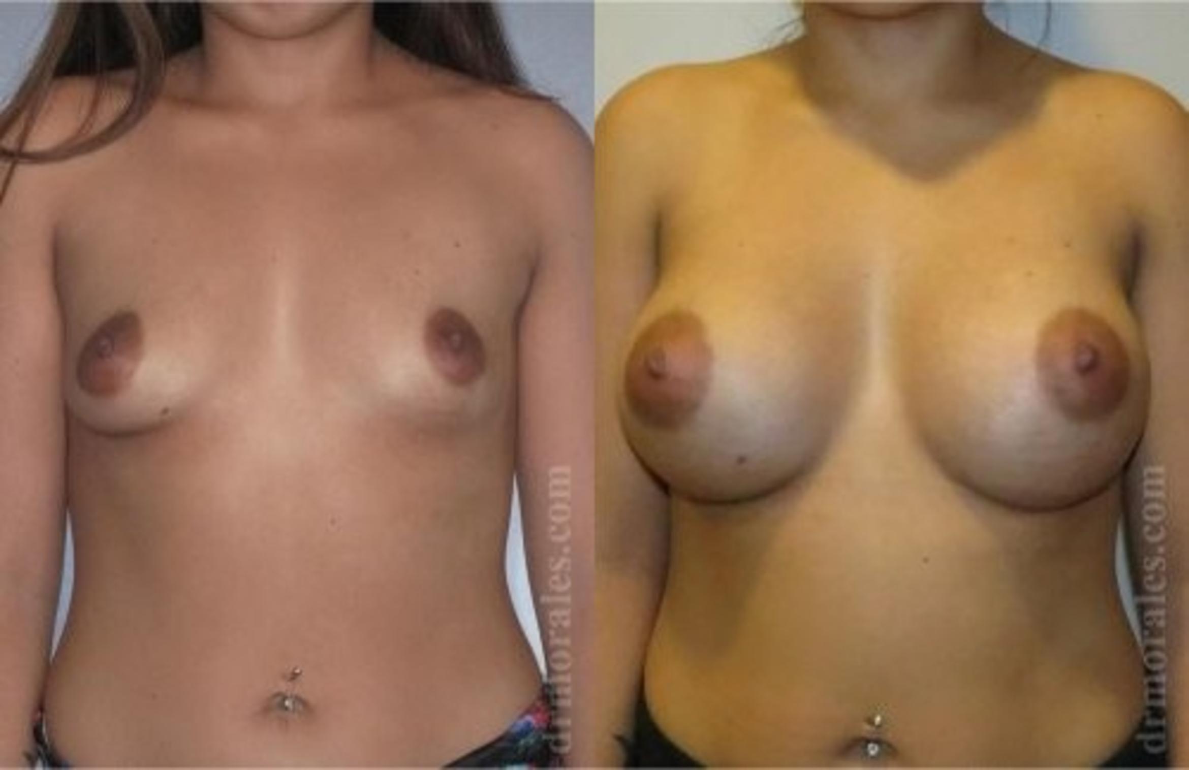 Before & After Breast Augmentation Case 808 View 1 View in Houston, TX