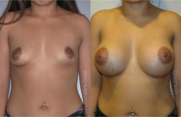 Before & After Breast Augmentation Case 808 View 1 View in Houston, TX