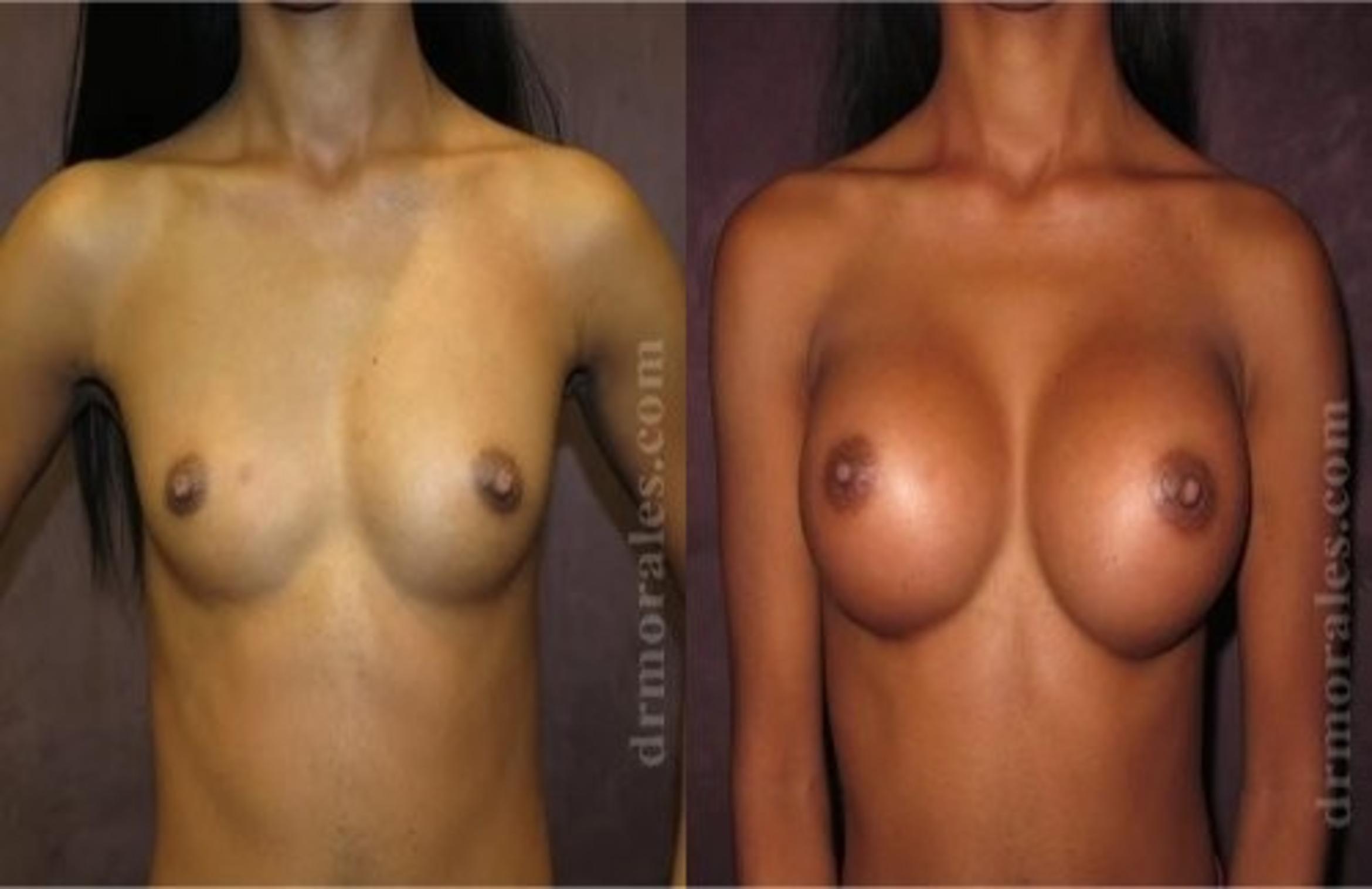 Before & After Breast Augmentation Case 809 View 1 View in Houston, TX