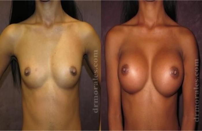 Before & After Breast Augmentation Case 809 View 1 View in Houston, TX