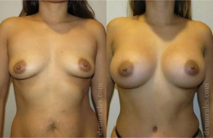 Before & After Breast Augmentation Case 810 View 1 View in Houston, TX