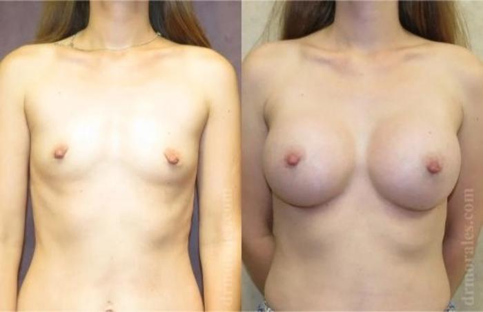 Before & After Breast Augmentation Case 811 View 1 View in Houston, TX
