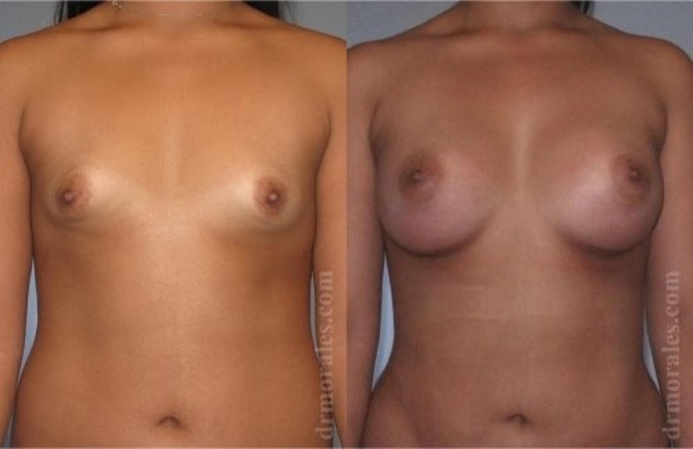 Before & After Breast Augmentation Case 812 View 1 View in Houston, TX