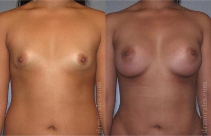 Before & After Breast Augmentation Case 812 View 1 View in Houston, TX