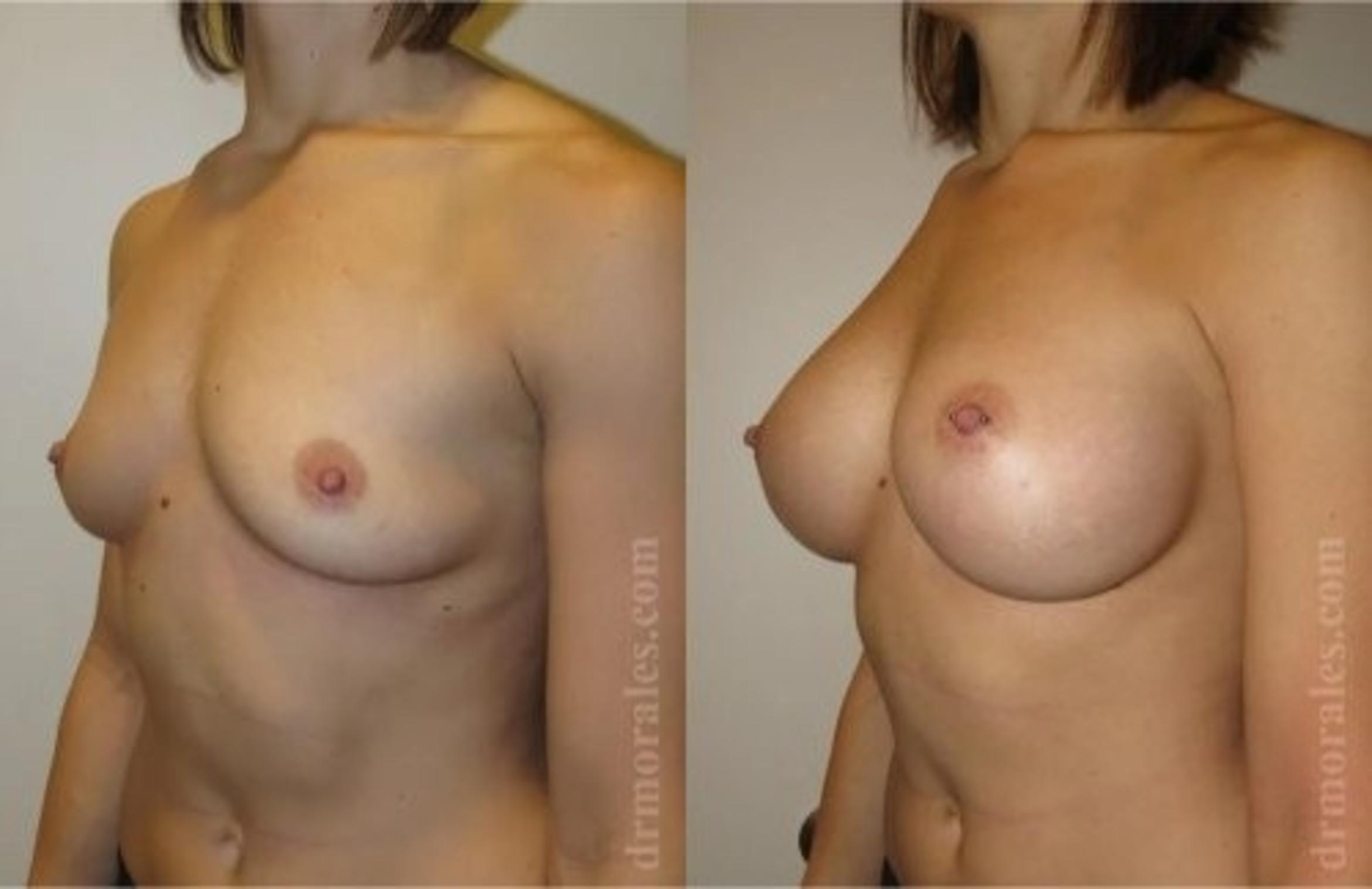 Before & After Breast Augmentation Case 814 View 1 View in Houston, TX