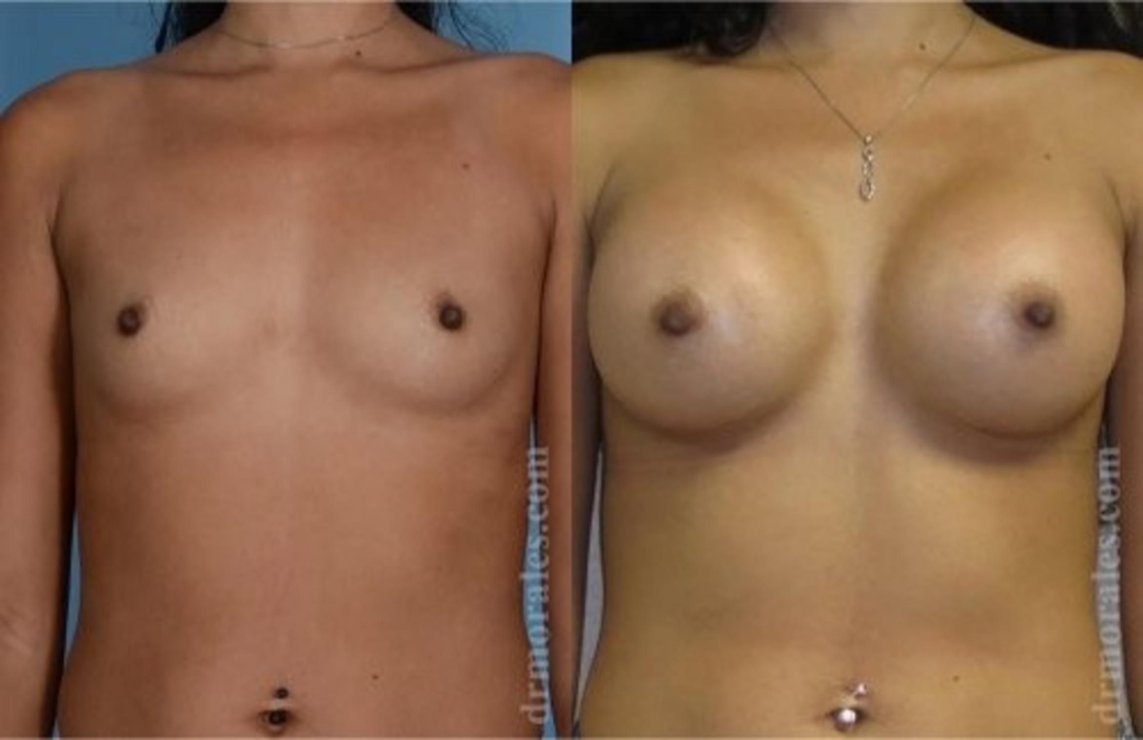 Before & After Breast Augmentation Case 815 View 1 View in Houston, TX