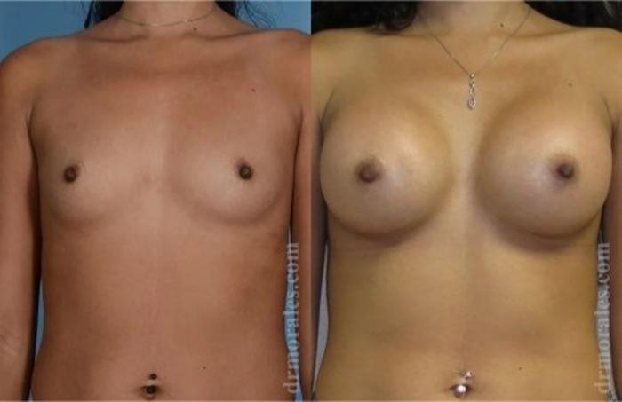 Before & After Breast Augmentation Case 815 View 1 View in Houston, TX