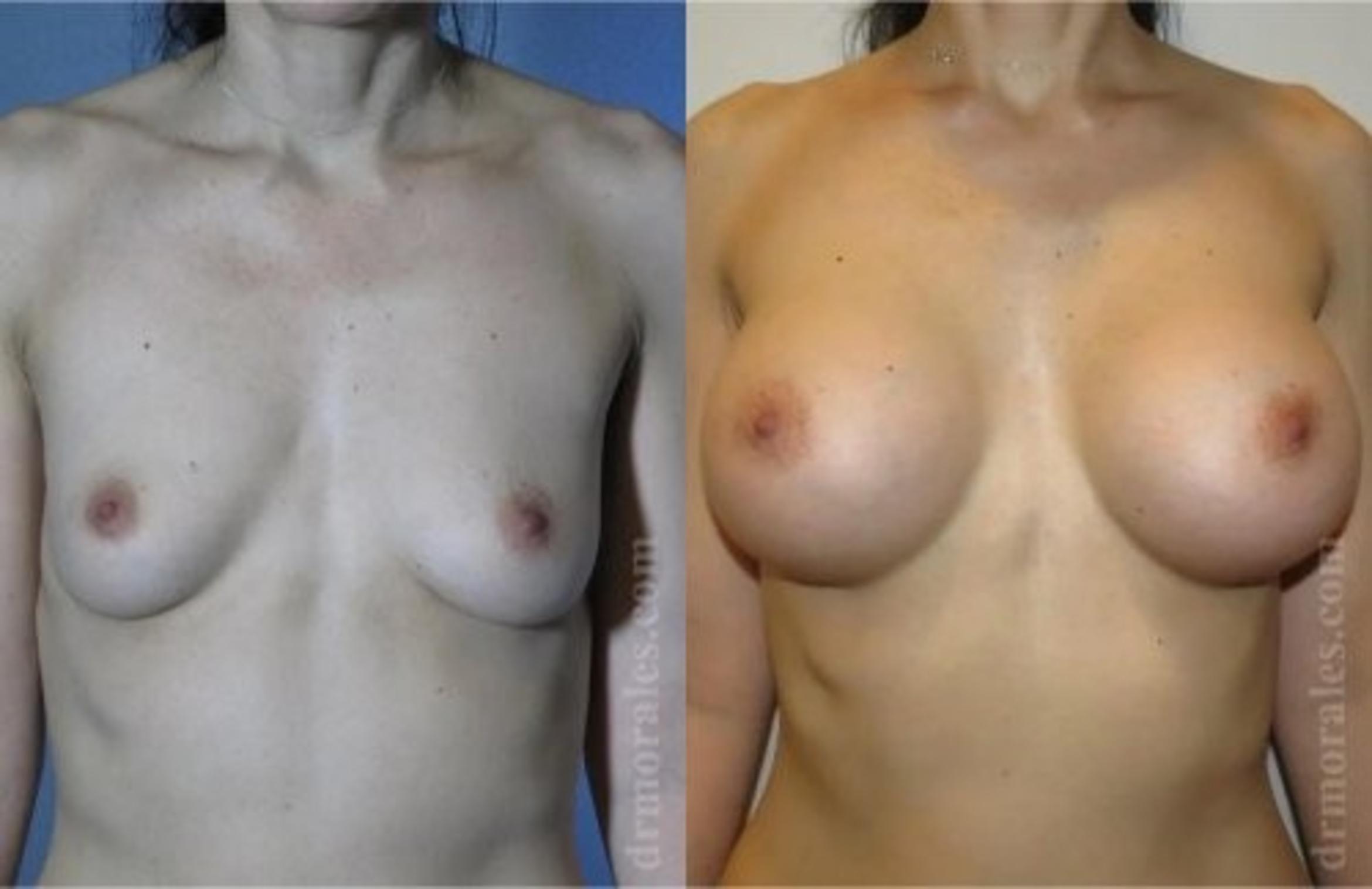 Before & After Breast Augmentation Case 816 View 1 View in Houston, TX