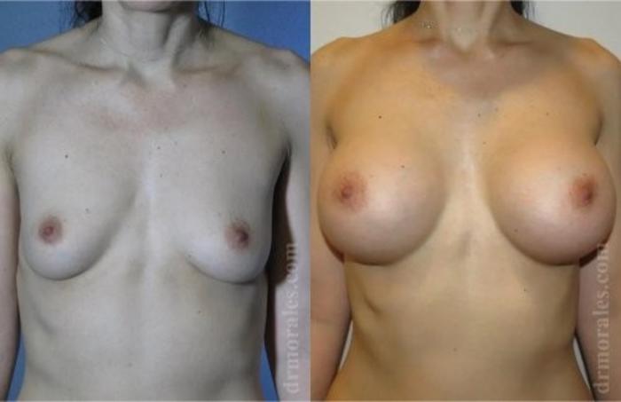 Before & After Breast Augmentation Case 816 View 1 View in Houston, TX