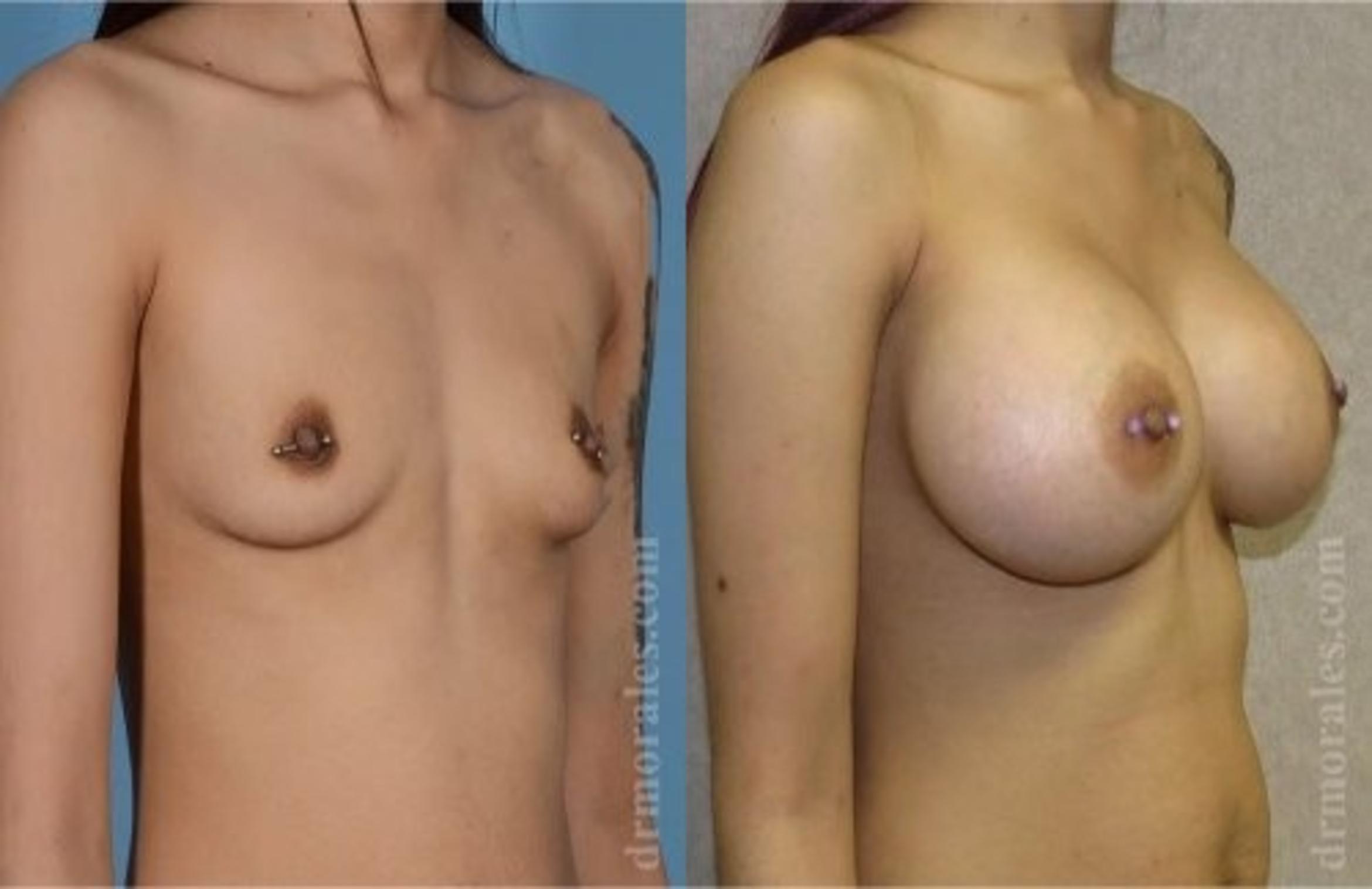 Before & After Breast Augmentation Case 817 View 1 View in Houston, TX