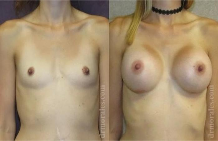 Before & After Breast Augmentation Case 818 View 1 View in Houston, TX