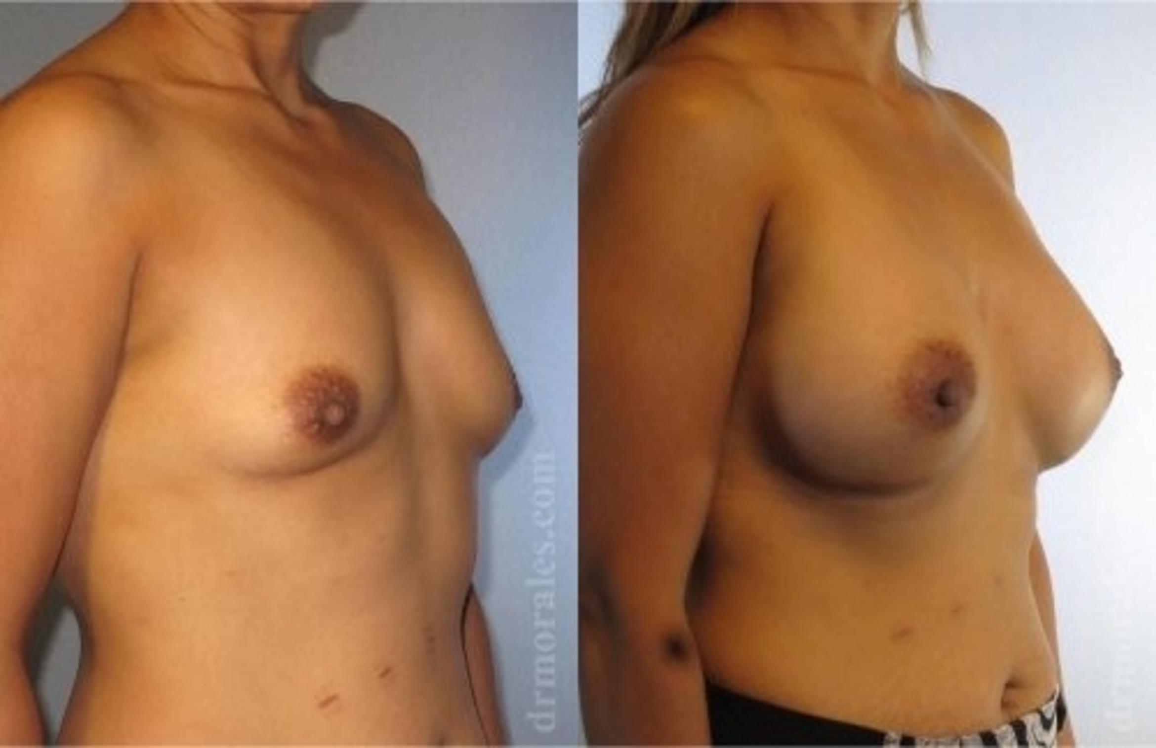 Before & After Breast Augmentation Case 819 View 1 View in Houston, TX