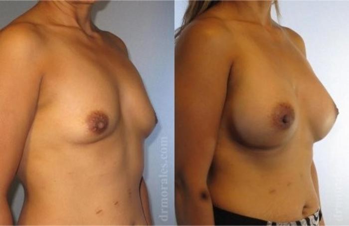 Before & After Breast Augmentation Case 819 View 1 View in Houston, TX